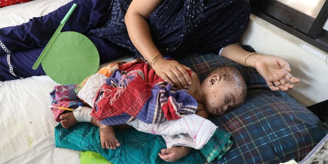 ২৫ বছরের রেকর্ড ভাঙলো হাম, বাড়ছে শঙ্কা