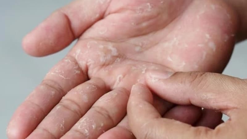 হাত-পায়ের চামড়া ওঠে এই ভিটামিনের অভাবে