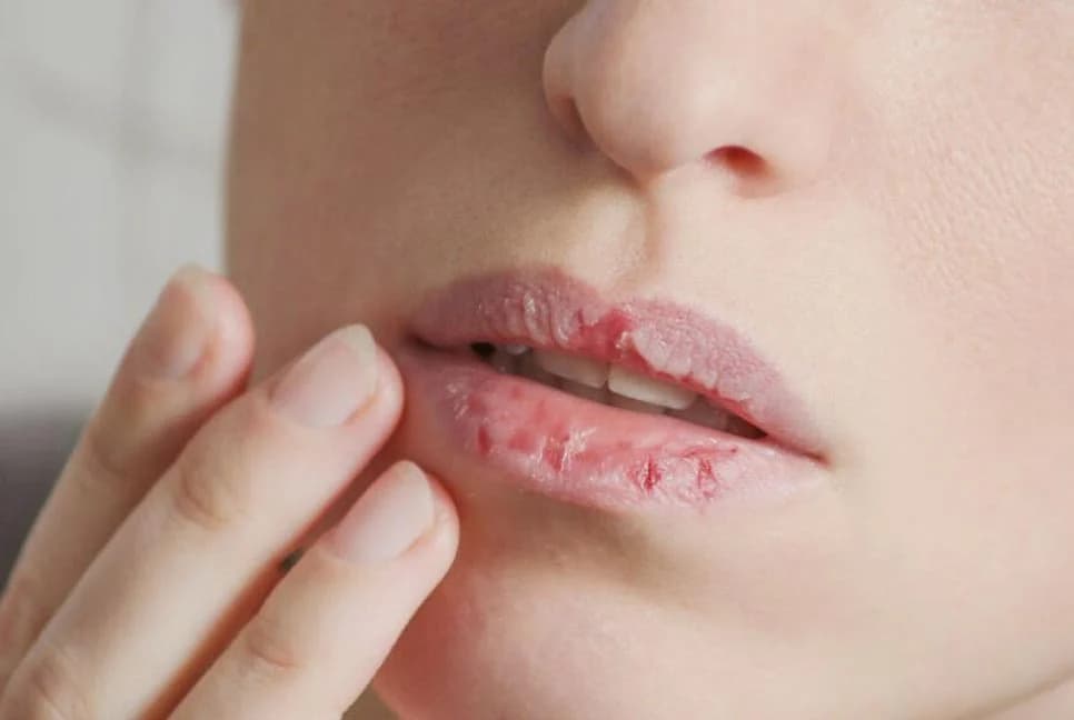 গরমেও ফাটছে ঠোঁট, প্রতিকার কী