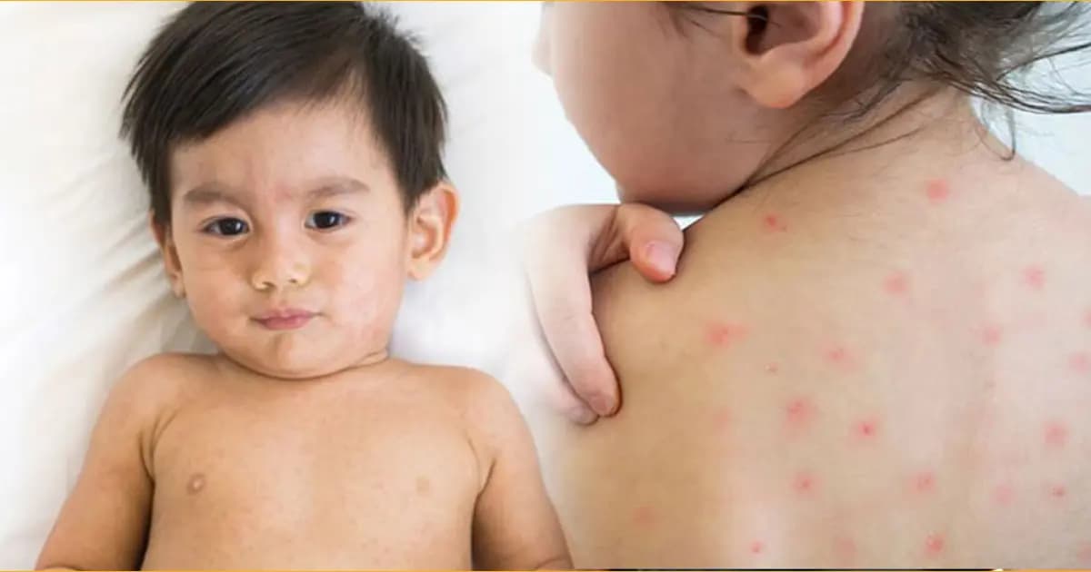 হাম থেকে শিশুকে বাঁচাতে যা জানা জরুরি