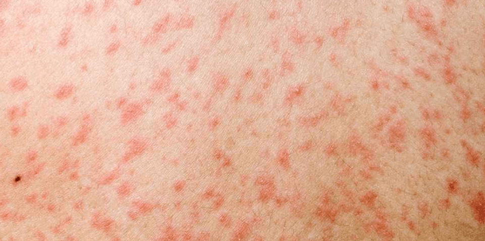 হামে মৃত্যু ২০০ ছাড়াল, ২৪ ঘণ্টায় আরও ৮ শিশুর প্রাণহানি